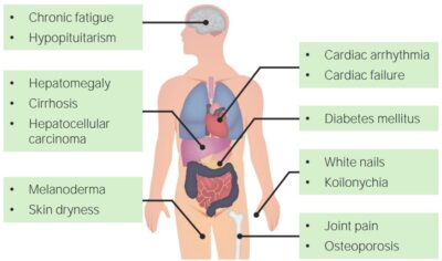 Hereditary Hemochromatosis | Concise Medical Knowledge