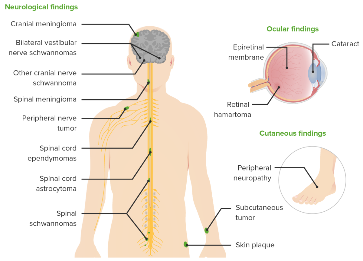 Clinical manifestations of nf2