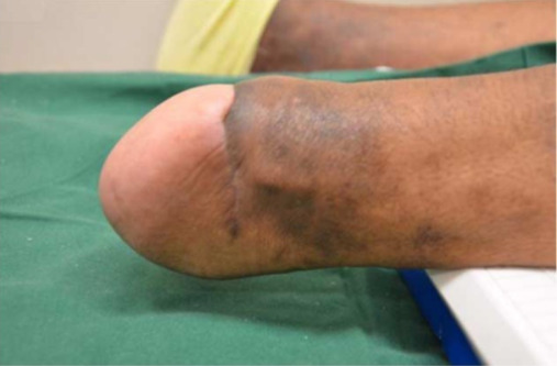 Clinical picture of a well-healed stump at 6-month follow-up