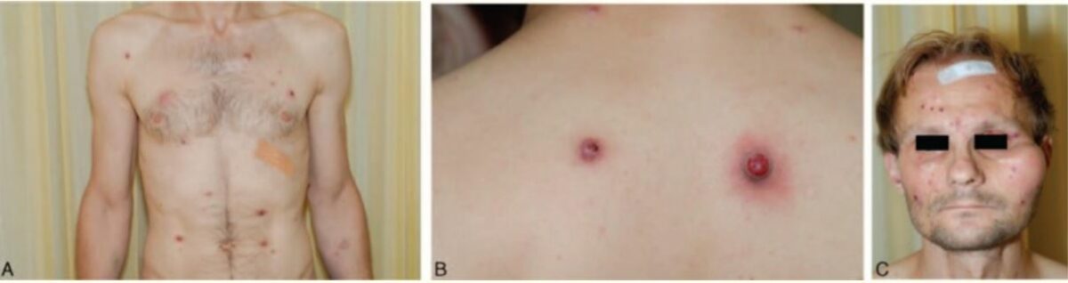 Clinical presentation of a patient with bacillary angiomatosis