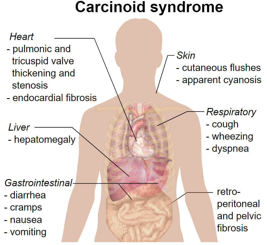 Apresentação clínica da síndrome carcinoide
