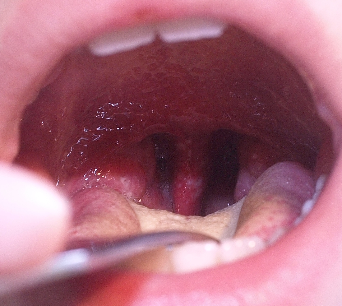 Resumo de herpangina: fisiopatologia, diagnóstico e tratamento