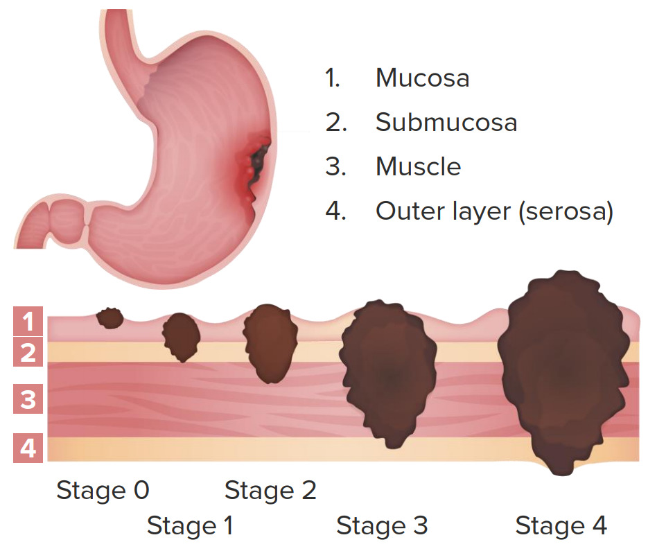 Clinical staging of gastric cancer