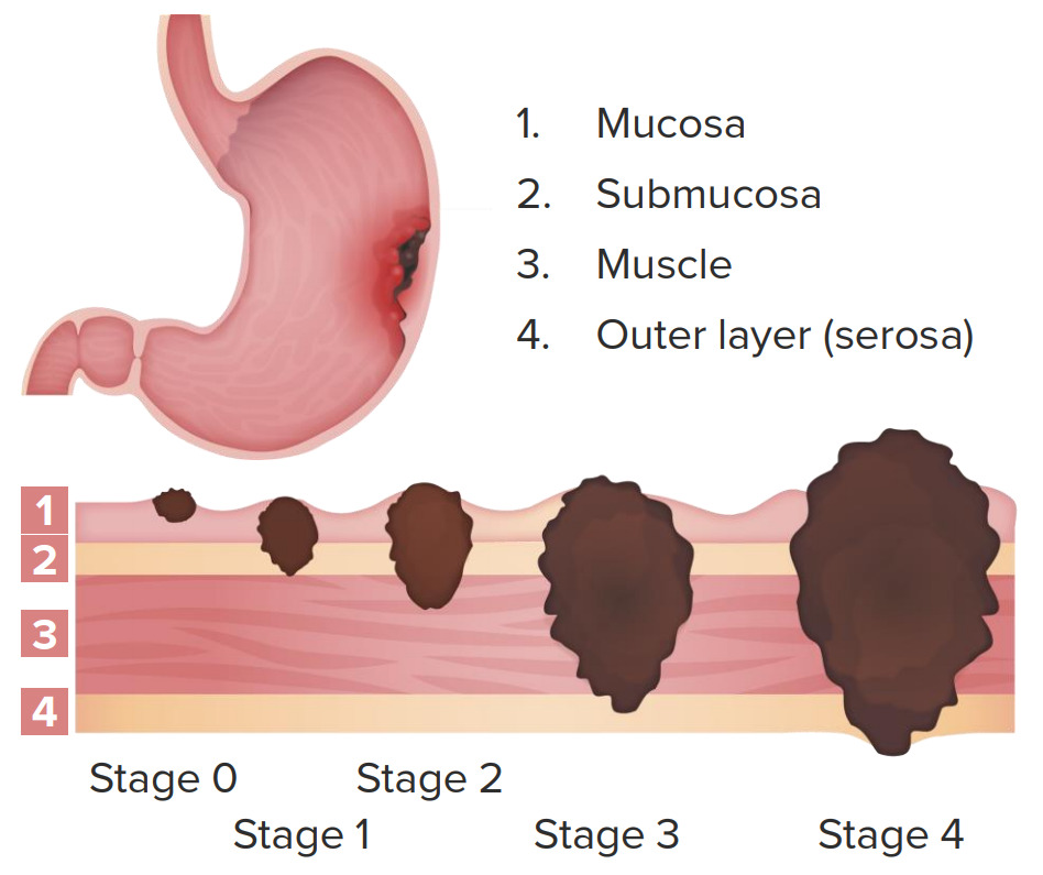 gastric cancer thesis