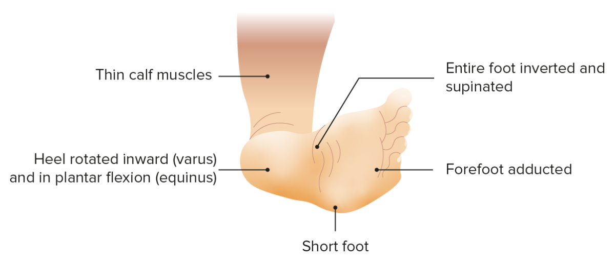 Clubfoot clinical presentation