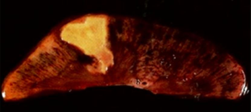 Coagulative necrosis in kidney tissue