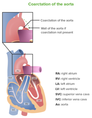 Coarctation of the Aorta | Concise Medical Knowledge