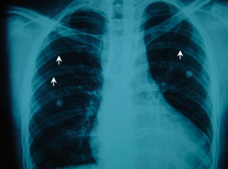 Coarctation of the aorta - x-ray