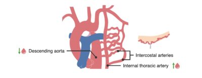 Collateral circulation in coarctation of the aorta