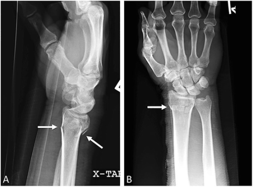 Colles fracture radiography