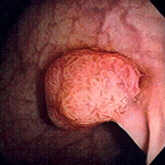 Pólipo de colon