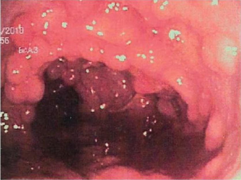 Colonic mucosa carpeted by adenomatous polyps in familial adenomatous polyposis fap