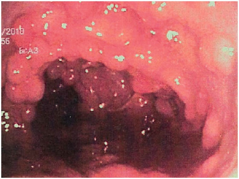 Colonic mucosa carpeted by adenomatous polyps