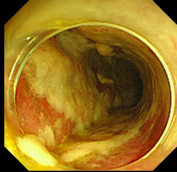 Colonic wall covered by thick pseudomembranes