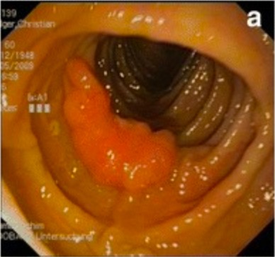 Colonoscopia que muestra tumor del colon descendente
