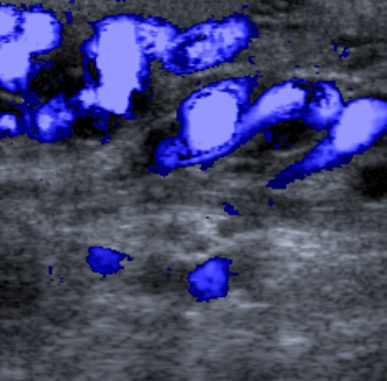 Color doppler ultrasound image variceal gonadal vein in the left inguinal canal