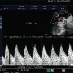 Color doppler of the umbilical artery