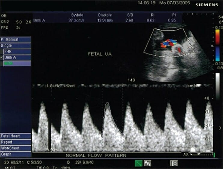 Color doppler of the umbilical artery