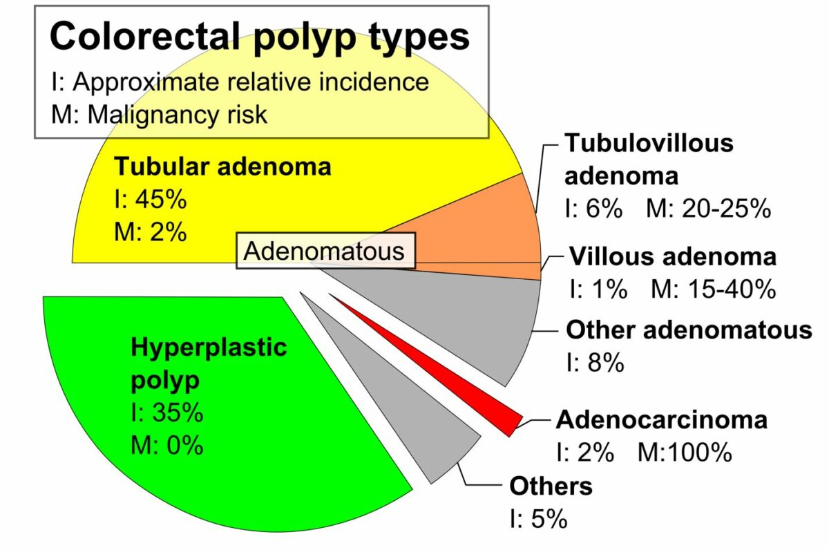 Tipos de pólipos colorretais