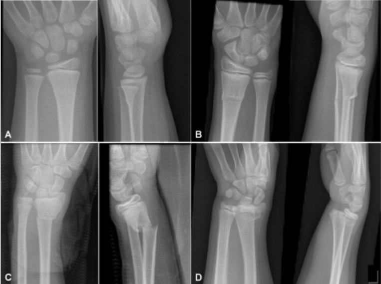 greenstick fracture x ray