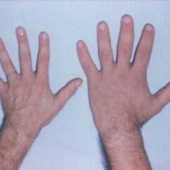Comparison of hands acromegaly