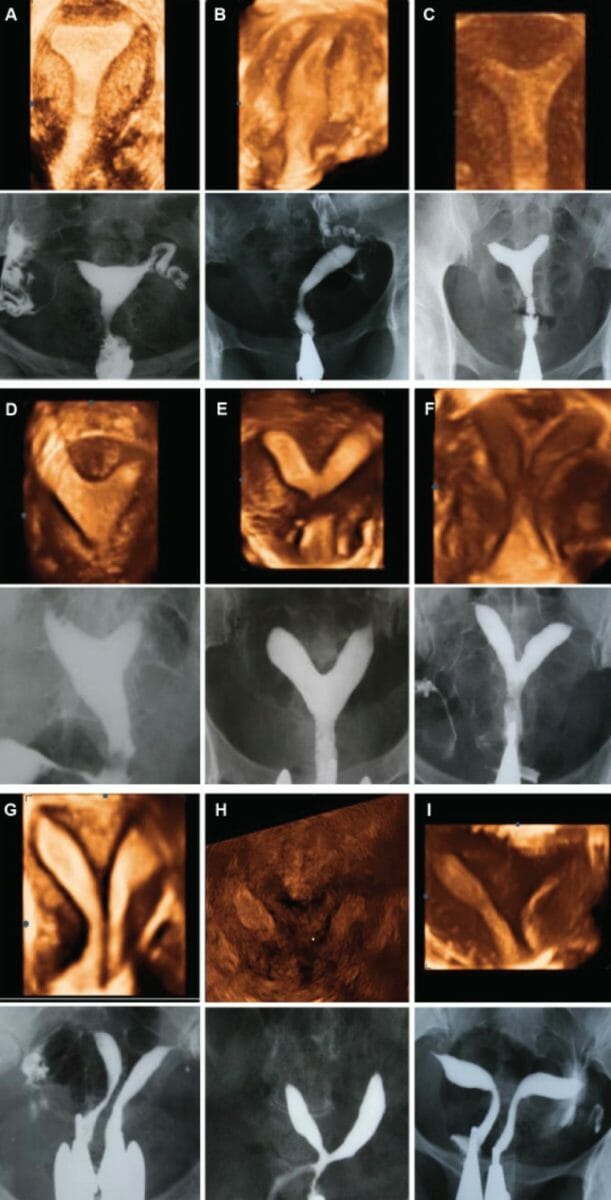 Comparison of three-dimensional ultrasound and hsg imaging in cases of uterine malformation