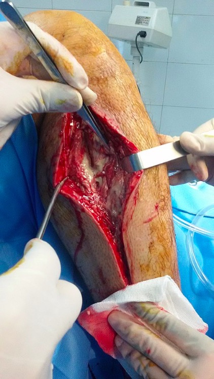 Compartment syndrome surgery