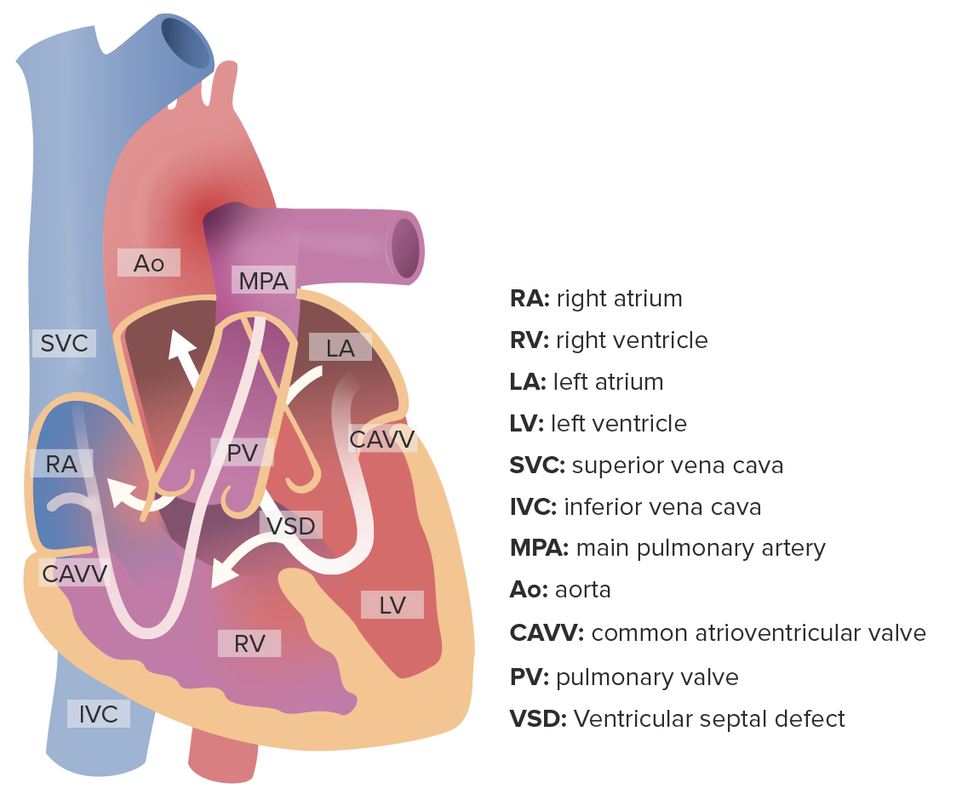 Xray Chest From An Infant With Large Ventricular Septal