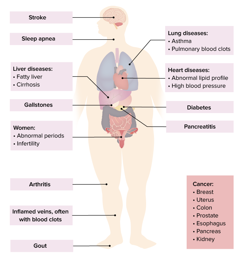 Complications of obesity