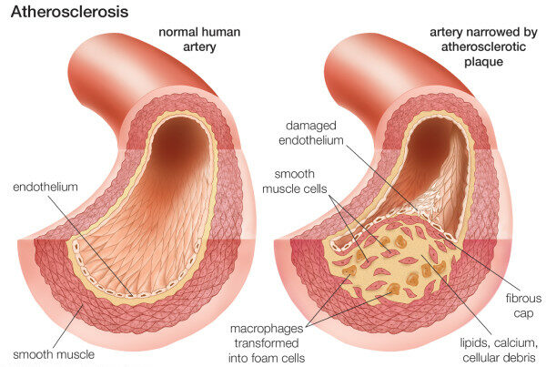 Coronary Heart Disease Concise Medical Knowledge