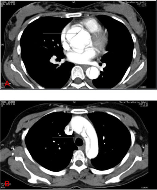 Computed tomography findings in aortic dissection