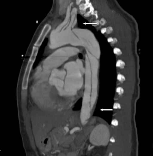 Aortic dissection extending into left subclavian and axillary arteries