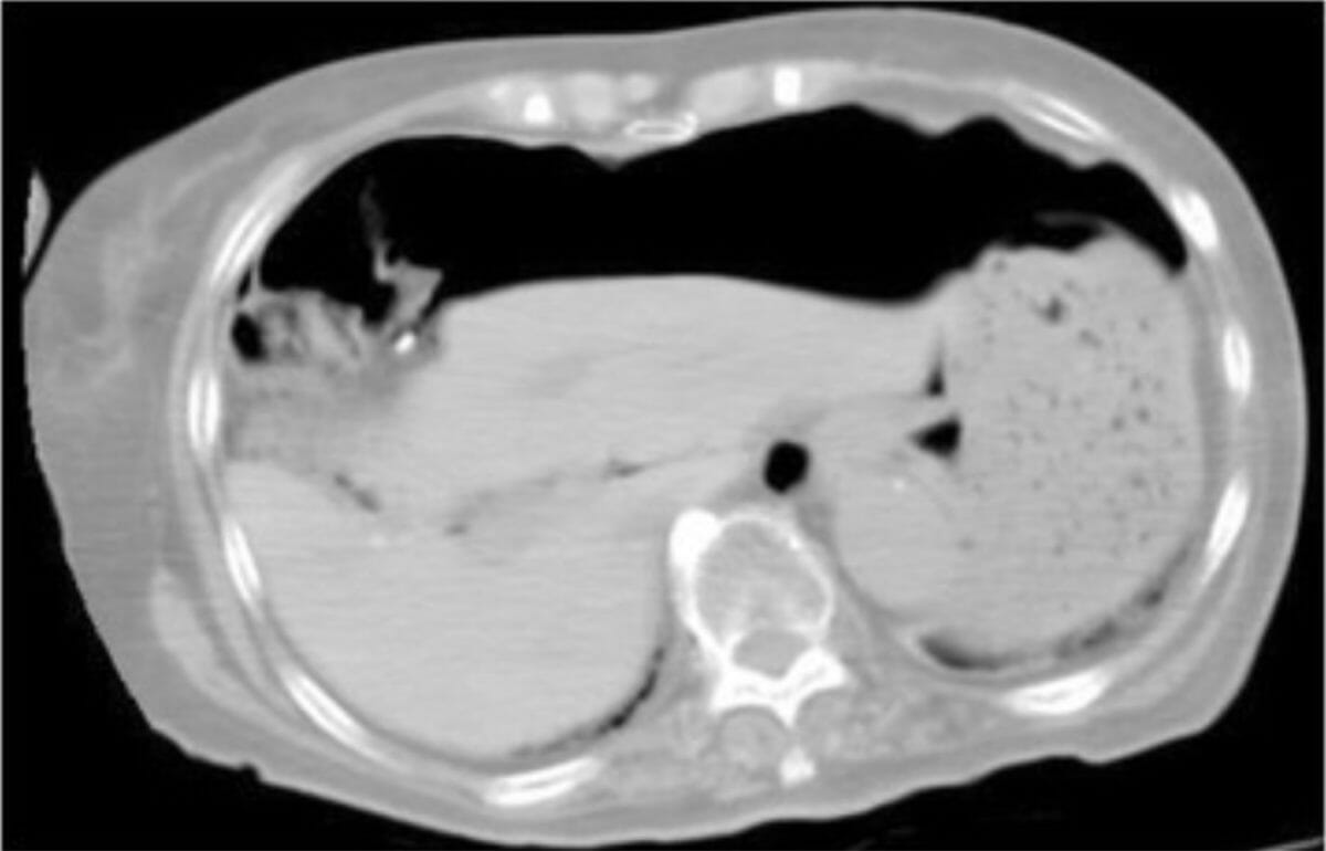 Computed tomography findings show a massive pneumoperitoneum