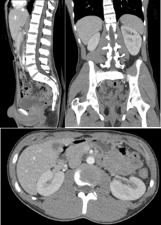 Ct of the abdomen and pelvis (with contrast)