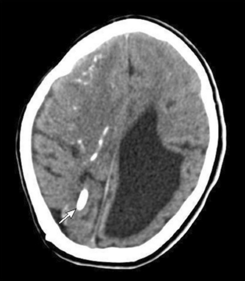 Computerized tomography of brain showing dilated ventricles with multiple subependymal and parenchymal calcifications