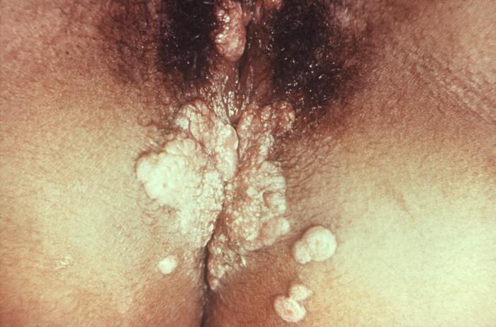 Condyloma lata secondary syphilis