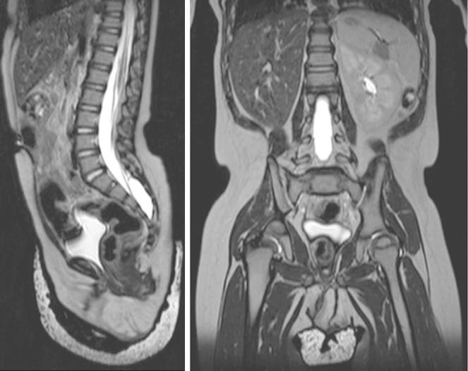 Congenital abnormalities of the kidney