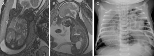 Congenital Diaphragmatic Hernias Concise Medical Knowledge