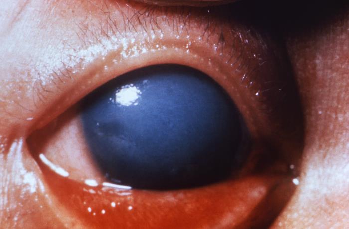 Congenital glaucoma rubella virus