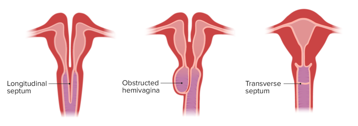 Congenital vaginal anomalies