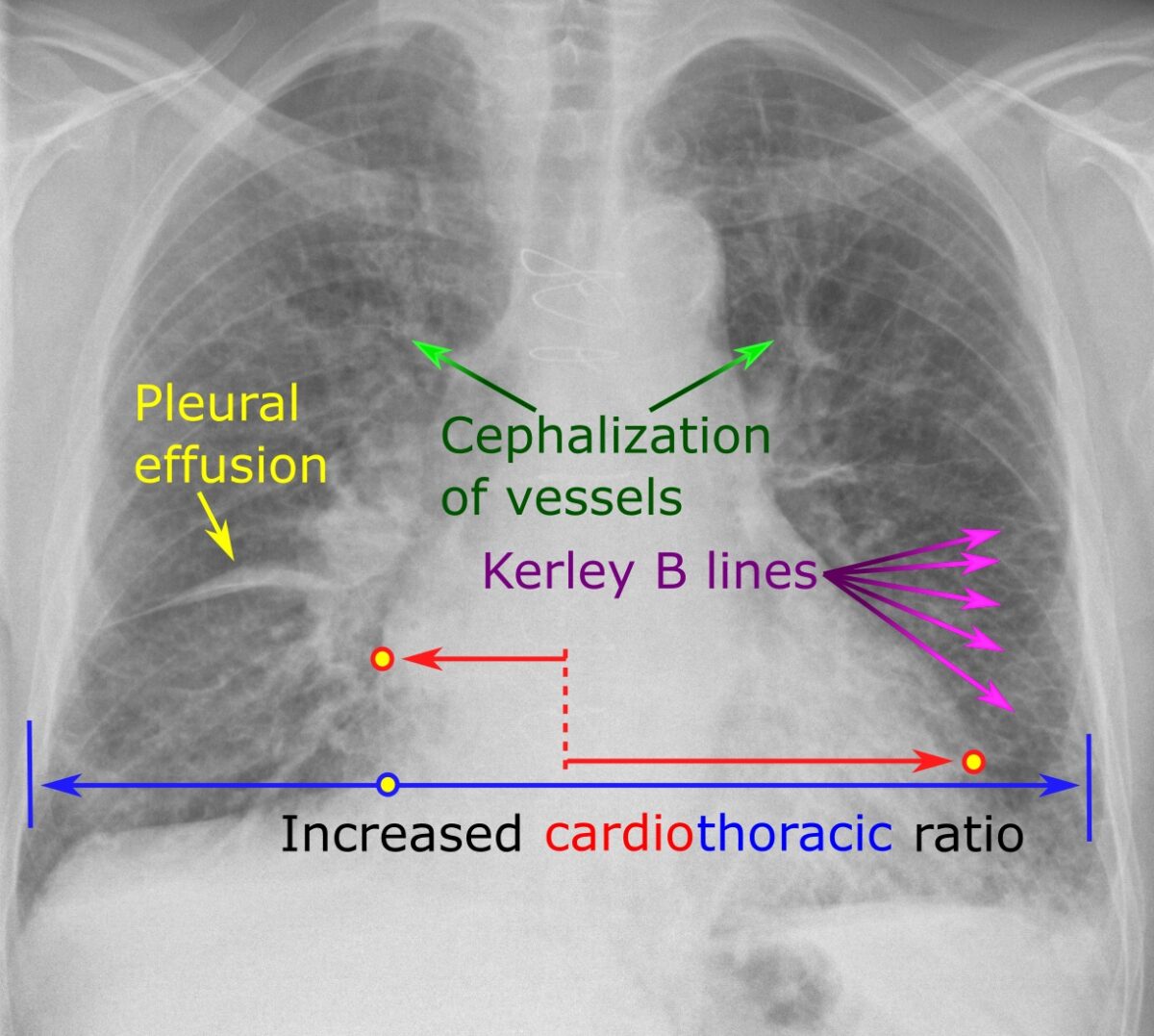 fluid retention congestive heart failure