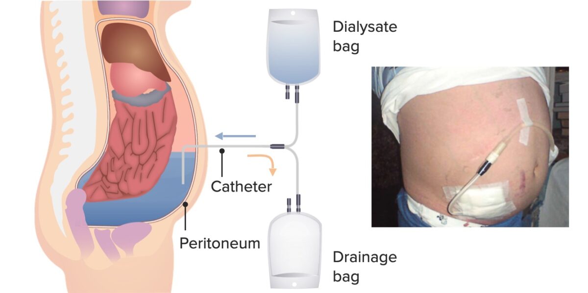 Continuous ambulatory peritoneal dialysis