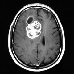 Contrast MRI showing glioblastoma multiforme