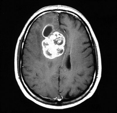 Astrocitoma | Concise Medical Knowledge