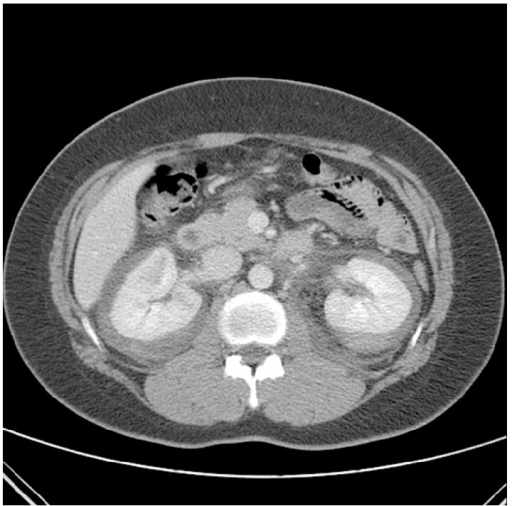 Contrast-enhanced ct with spontaneous bilateral perirenal hemorrhage (rare complication) as the initial presentation of pan in an individual with flank pain and hypovolemia