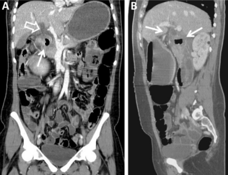 Contrast-enhanced coronal and sagittal ct of the abdomen and pelvis
