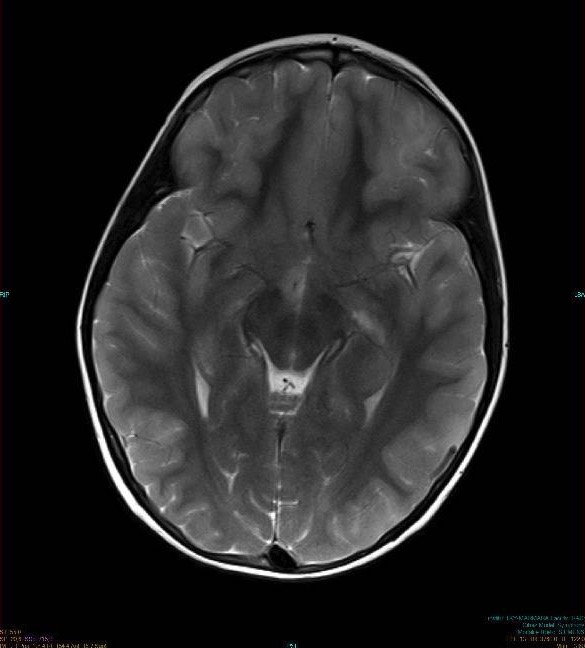 Aumento de contraste no lado posterior do córtex insular bilateral, hipotálamo direito e córtex frontal esquerdo inferior consistente com encefalite