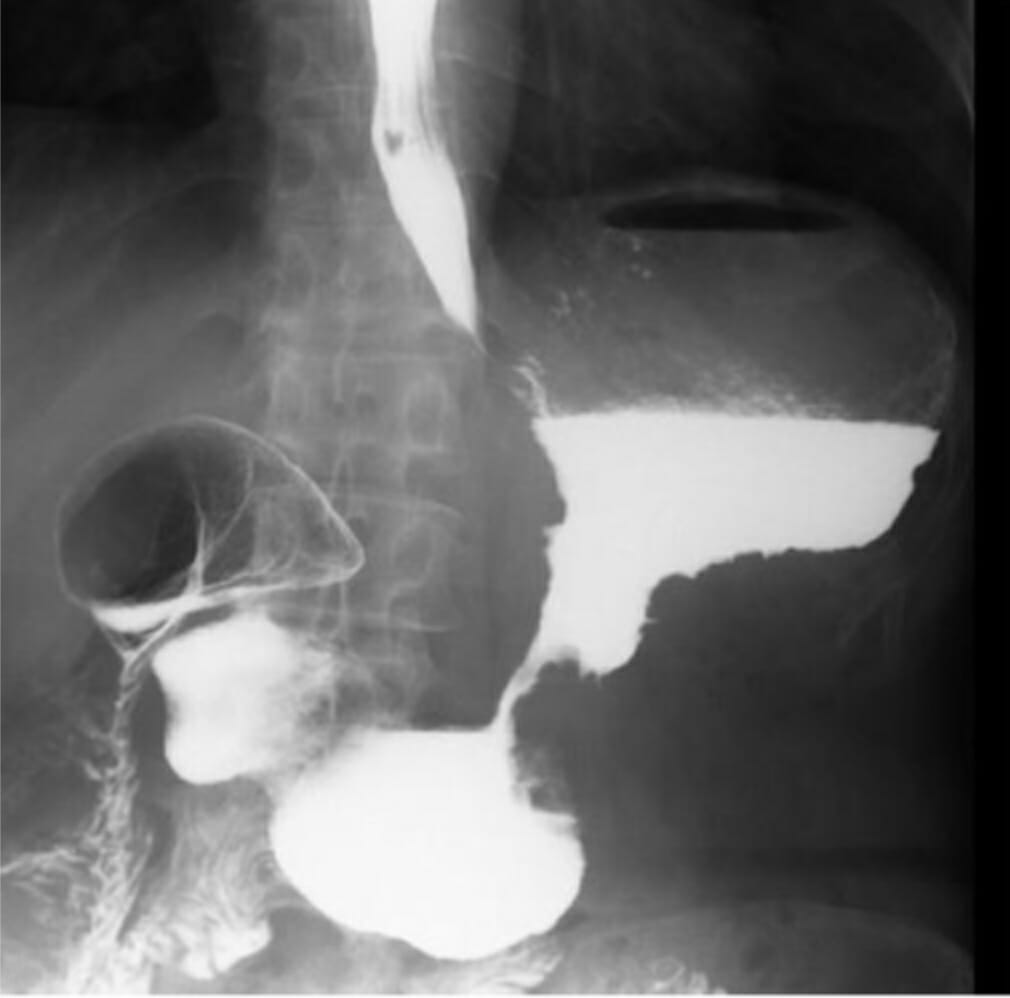 Radiografía contrastada de nuestro paciente en su visita inicial