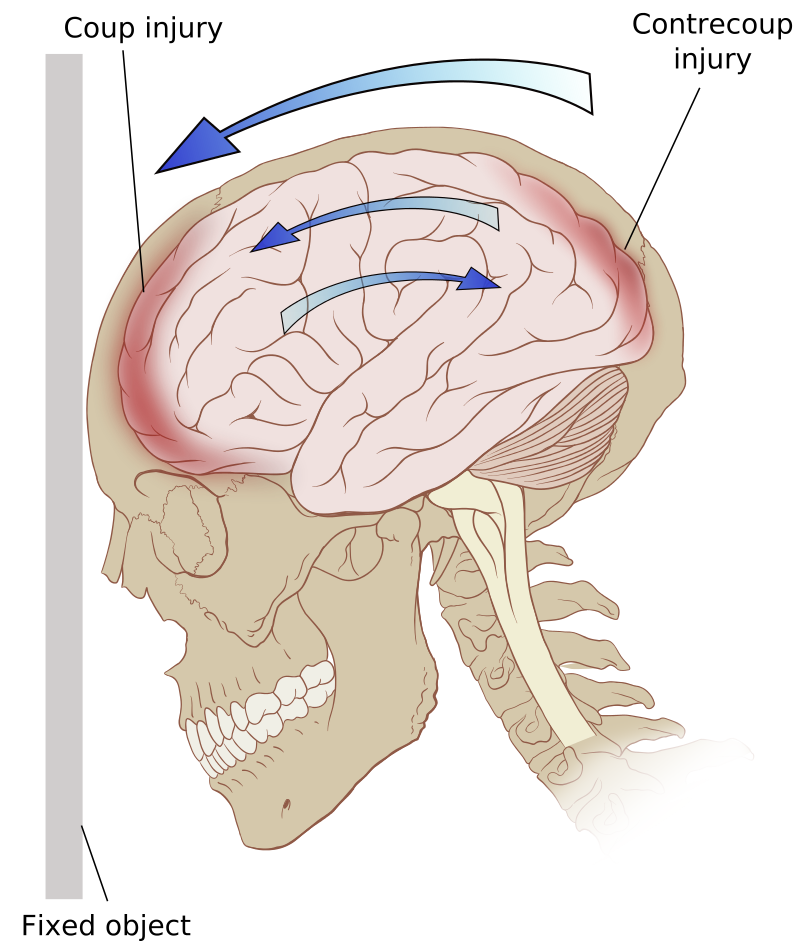 Of skull signs fracture basilar Basilar skull