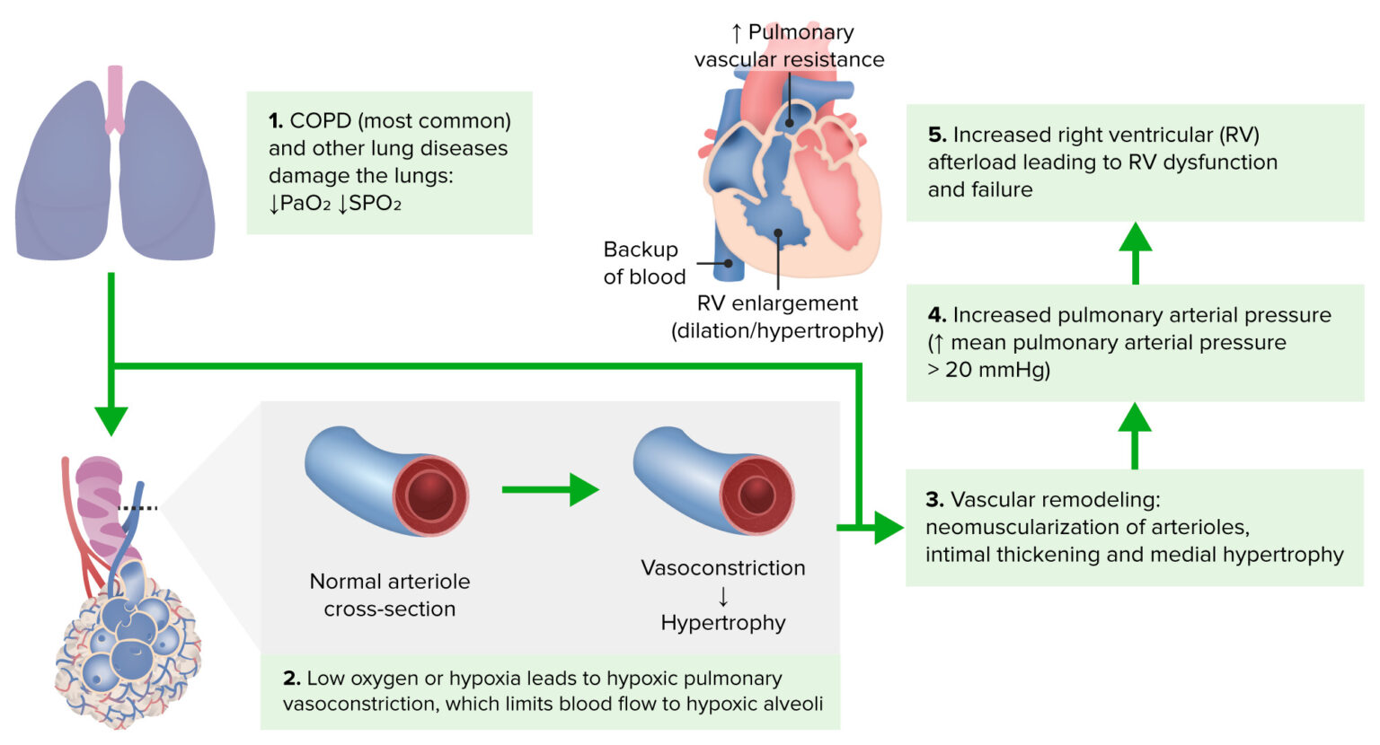 Cor Pulmonale | Concise Medical Knowledge